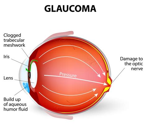 Glaucoma The Signs Symptoms And Solutions Ocular Prosthetics Inc