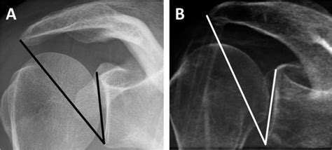 Critical Shoulder Angle Measured A On A Conventional Radiograph And