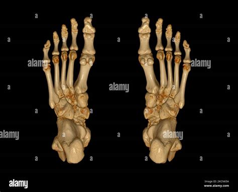 D Ct Scan Cheville Banque De Photographies Et Dimages Haute