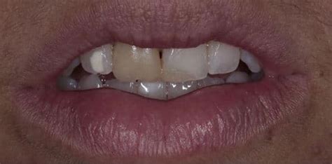 Dental Veneers In Los Angeles Cosmetic Dentist Dr Anthony Mobasser