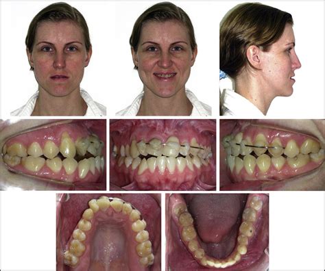 Pretreatment Facial And Intraoral Photographs Download Scientific