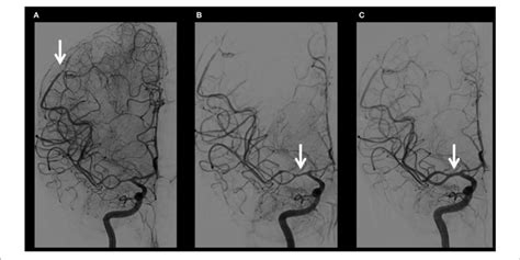 Illustration Of Cerebral Digital Subtraction Angiographies Dsa Over