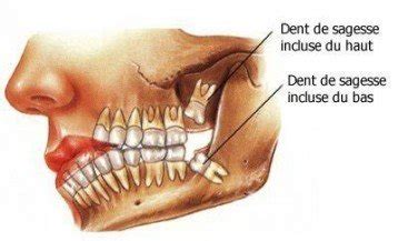 Dents De Sagesse Prix Et D Roulement De L Extraction