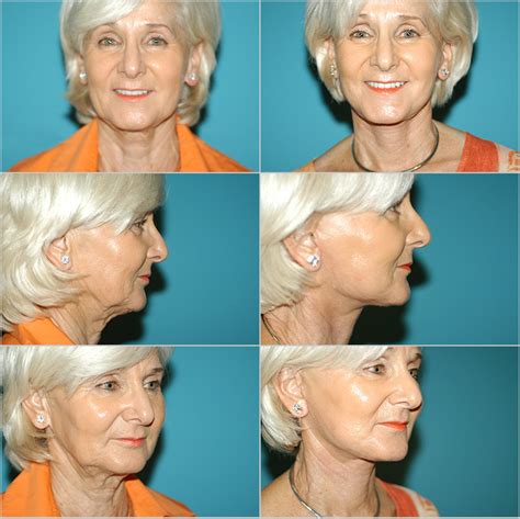 Plastic Surgery Neck Lift Procedure