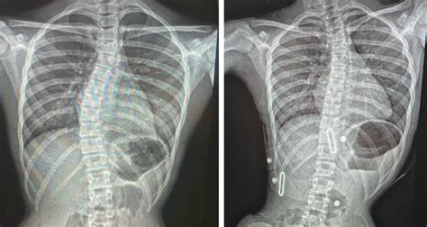 Scoliosis X Ray Before And After