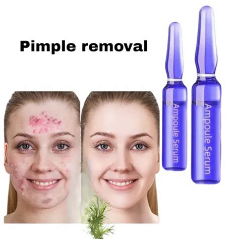 Pimple Cream, Pimple Clear Serum For Women, Pimple Removal Cream ...