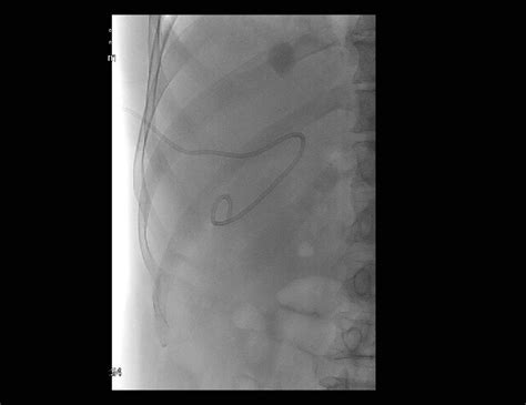 Percutaneous cholecystostomy. The tube was inserted into the gall ...