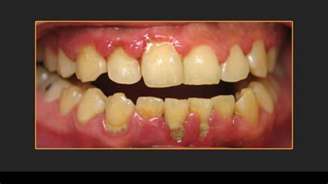 Perio Protect Marietta Ga Gum Treatment Periodontitis