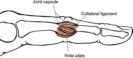 Hand Therapy Volar Plate Injury North Tees And Hartlepool NHS