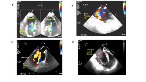 Tricuspid valve regurgitation management with valve replacement Late ...