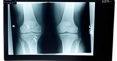 ACL Surgery | ACL Reconstruction Procedure Details, Risks & Recovery