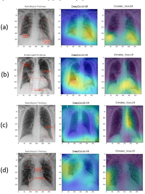 Figure 16 From Deep Learning Applied To Chest Radiograph Classification