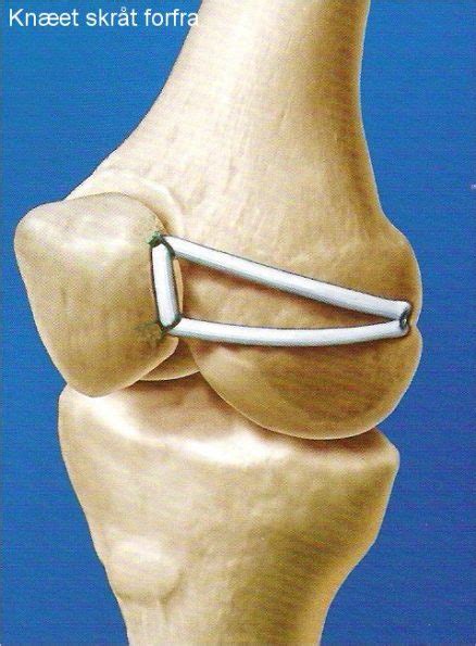 MPFL reconstruction is a reconstruction of the inner ligament that holds the kneecap