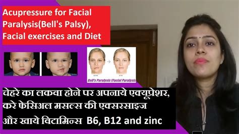 Facial Paralysis Bell S Palsy Acupressure Bell S Palsy Recovery Diet Bell S Palsy Exercise