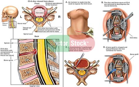 Neck Surgery: Neck Surgery Herniated Disc Recovery