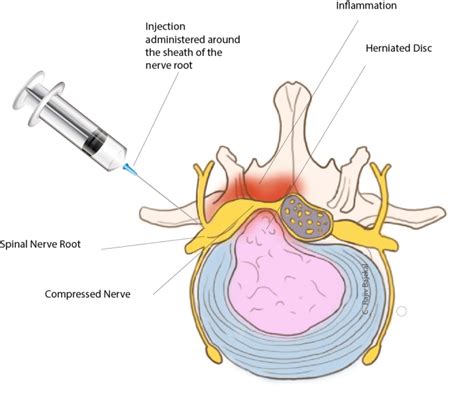 Nerve Root Blocks Rajiv Bajekal