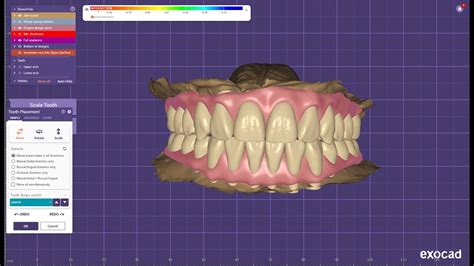 Exocad Designing For Upper Titanium Bar Screw Retained Implant With