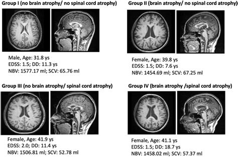 Representative High Resolution Dt Mprage Showing The Distinct Atrophy