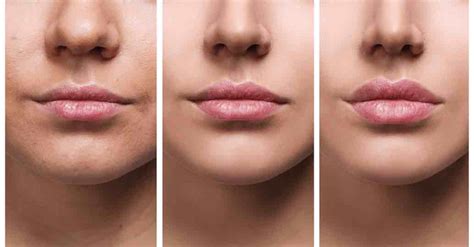 Botox ácido Hialurônico E O Lip Lift Ajudam No Rejuvenescimento