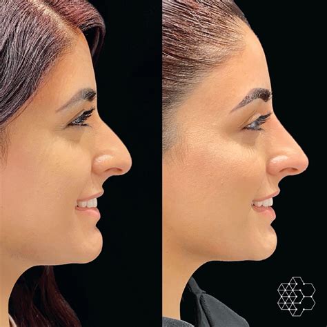 Liquid Rhinoplasty Vs Surgical Rhinoplasty Skin Technique