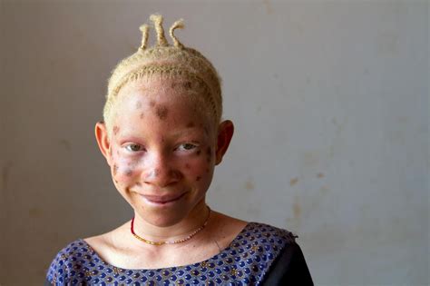 Pictures Inside The Lives Of Albinos In Tanzania Albinism Albino