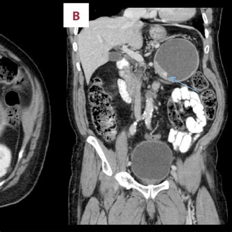 Axial And Coronal Contrast Enhanced Abdominal Computed Tomography Ct