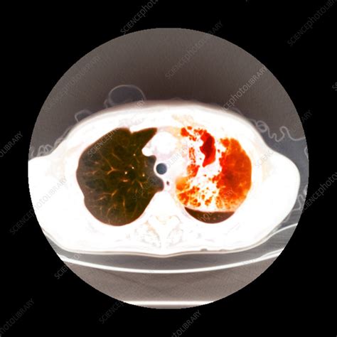 Lung abscess, CT scan - Stock Image - C007/3779 - Science Photo Library