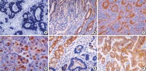 Representative Features Of In Situ Hybridization For Epstein Barr Virus Download Scientific