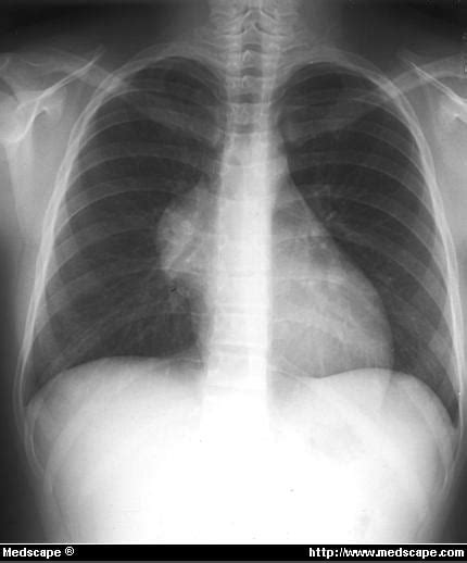 Chest Radiograph Showing Right Hilar Mass