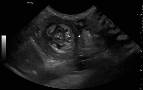 Noninvasive Hydrostatic Reduction Of An Ileocecocolic Intussusception