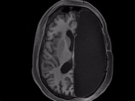 indian led team   discovers pathbreaking treatment  brain cancer