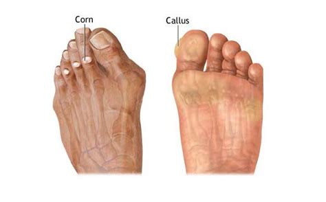 callus-corn - Podiatry First