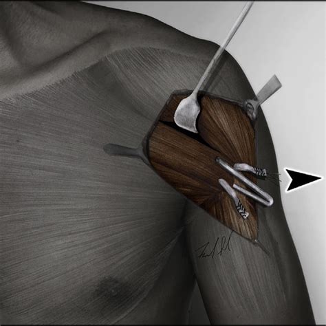 Pdf Pectoralis Major Tendon Reconstruction Using Semitendinosus