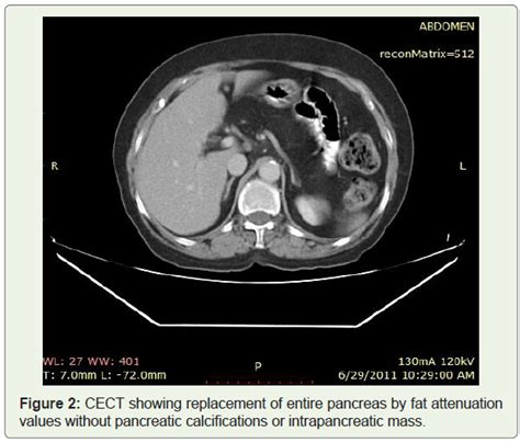 CT MRI Findings In A Rare Case Of Total Fat Replacement Of Pancreas