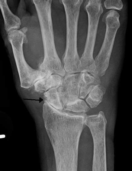 Wrist Osteoarthritis Alchetron The Free Social Encyclopedia