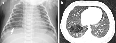 Type Congenital Pulmonary Airway Malformation Cpam In An