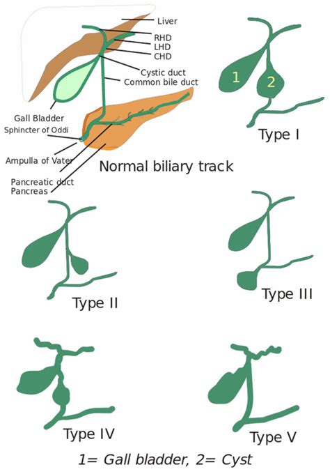 Choledochal Cyst Types Causes Symptoms Diagnosis And Treatment