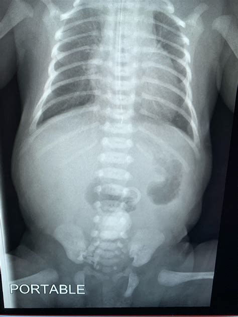 Double Bubble Duodenal Atresia Rradiology