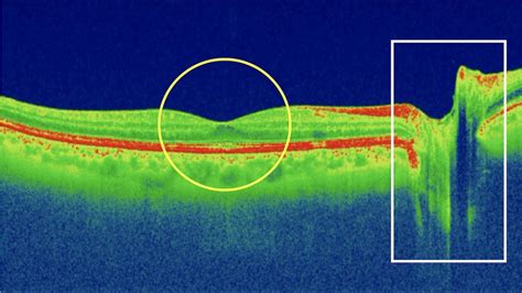 Capas De La Retina En Oct Youtube