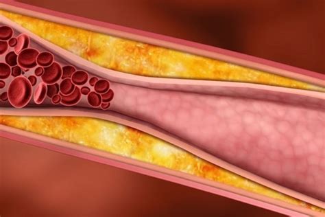 Valores Normales Para Cada Tipo De Colesterol Ldl Hdl Vldl Y Total Tua Saúde