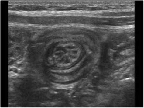 Intussusception Stool