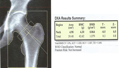 Dexa Scan Numbers Chart