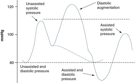 Usefulness Of Intra Aortic Balloon Pump Counterpulsation American