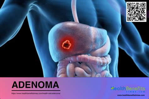 Adenoma | Health Benefits