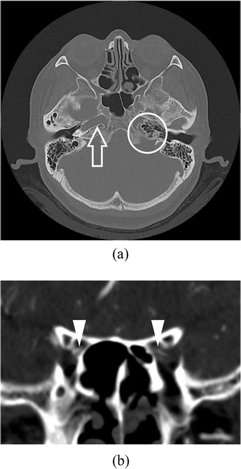 An Axial Computed Tomography A Image In The Bone Window At The Skull