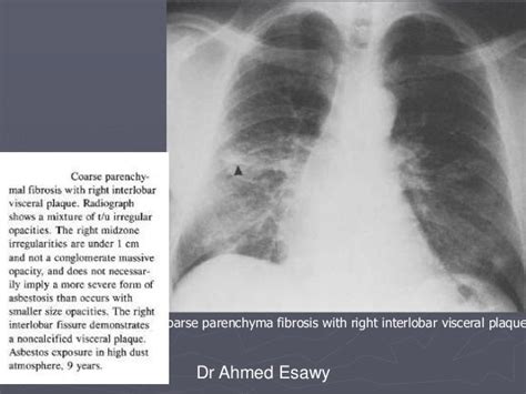 What Is Bilateral Apical Pleural Thickening Treatment