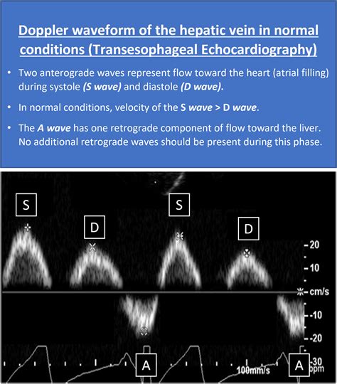 Improved Right Ventricular Diastolic Function Assessed By Hepatic Vein