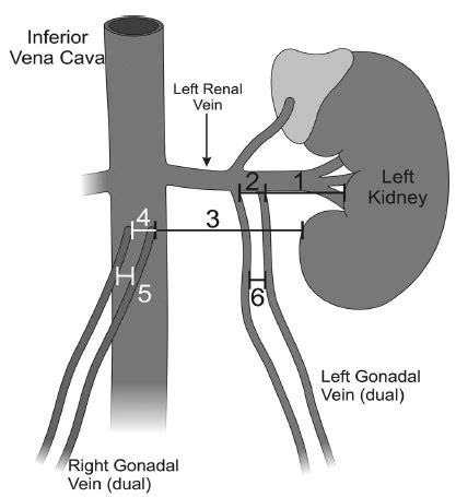 Duplicaci N Bilateral De Las Venas Gonadales Reporte De Caso