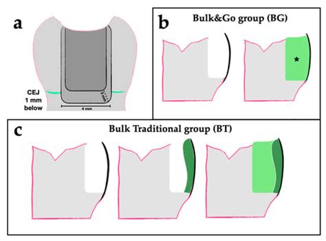 Microleakage Analysis Of Different Bulk Filling Techniques For Class II