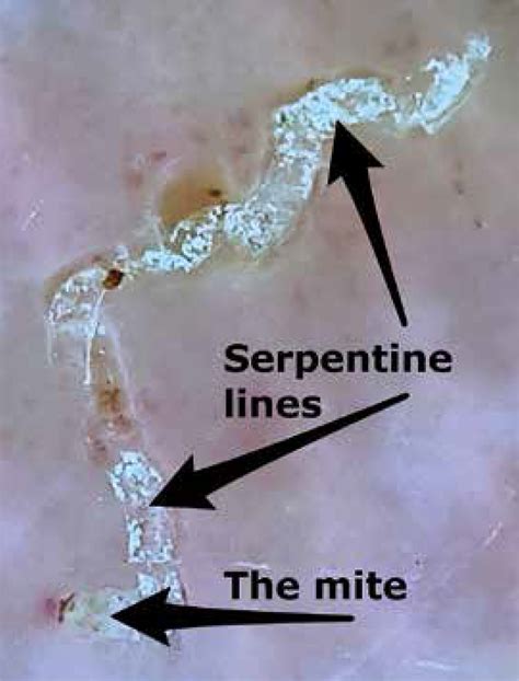 Dermoscopy, light microscopy, and real-time polymerase chain reaction ...